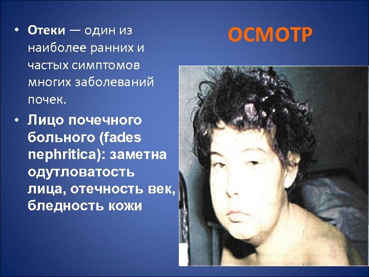  • Отеки — один из наиболее ранних и частых симптомов многих заболеваний почек.