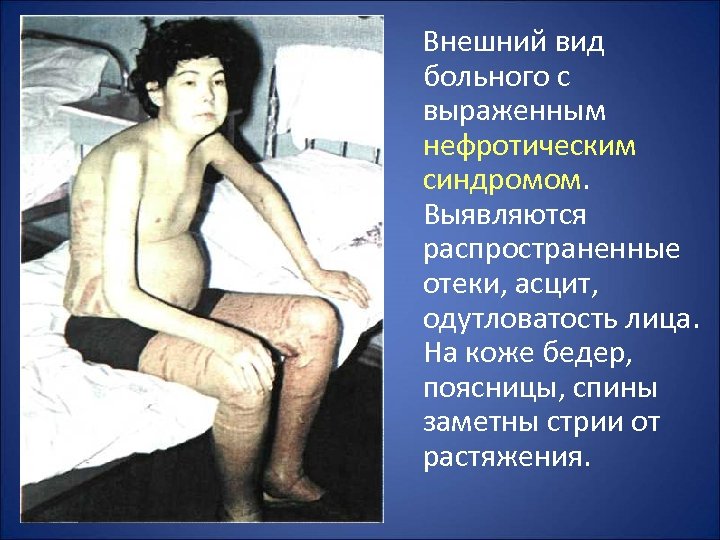 Внешний вид больного с выраженным нефротическим синдромом. Выявляются распространенные отеки, асцит, одутловатость лица. На