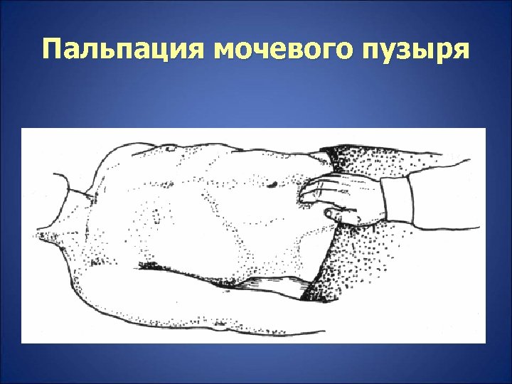 Пальпация мочевого пузыря 