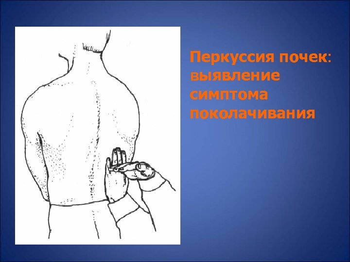 Перкуссия почек: выявление симптома поколачивания 