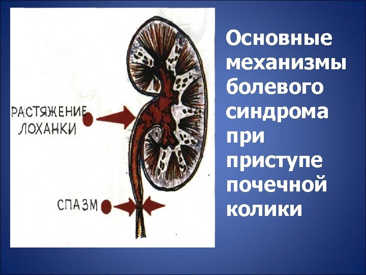 Основные механизмы болевого синдрома приступе почечной колики 