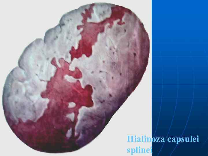 Hialinoza capsulei splinei 