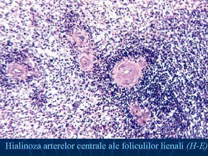 Hialinoza arterelor centrale foliculilor lienali (H-E) 