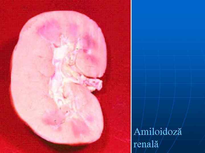 Amiloidoză renală 