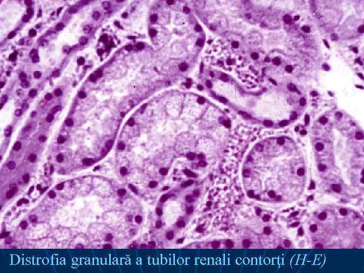 Distrofia granulară a tubilor renali contorţi (H-E) 