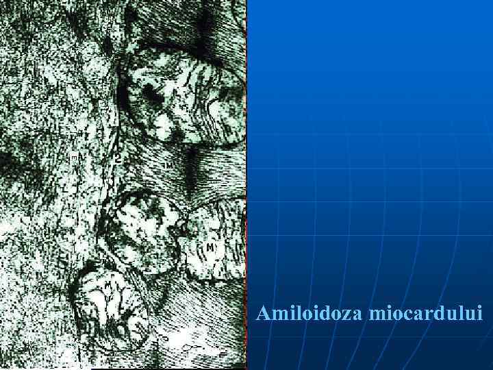 Amiloidoza miocardului 