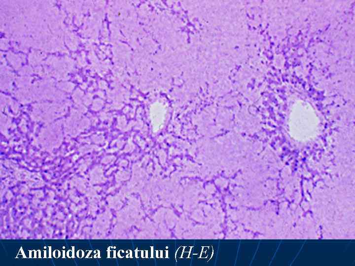 Amiloidoza ficatului (H-E) 