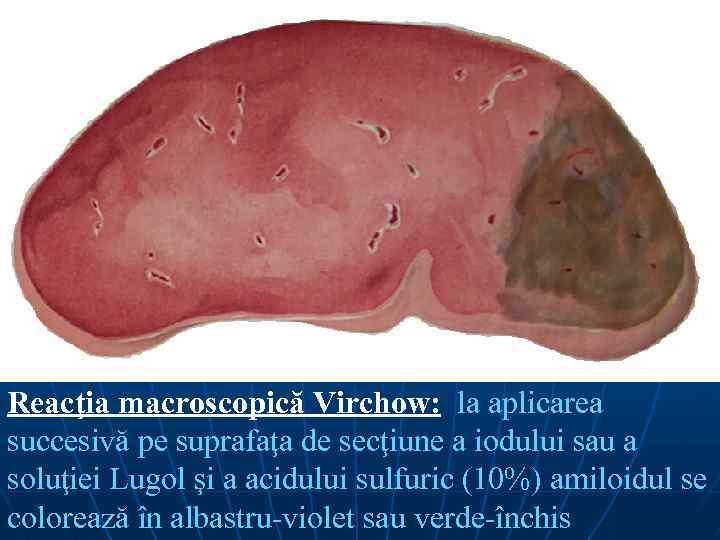 Reacţia macroscopică Virchow: la aplicarea succesivă pe suprafaţa de secţiune a iodului sau a