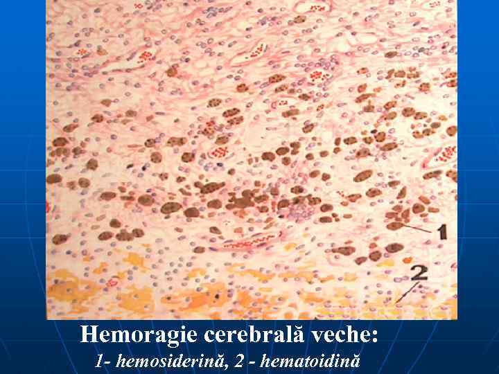 Hemoragie cerebrală veche: 1 - hemosiderină, 2 - hematoidină 