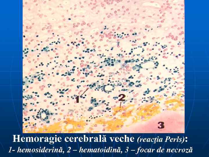 Hemoragie cerebrală veche (reacţia Perls): 1 - hemosiderină, 2 – hematoidină, 3 – focar