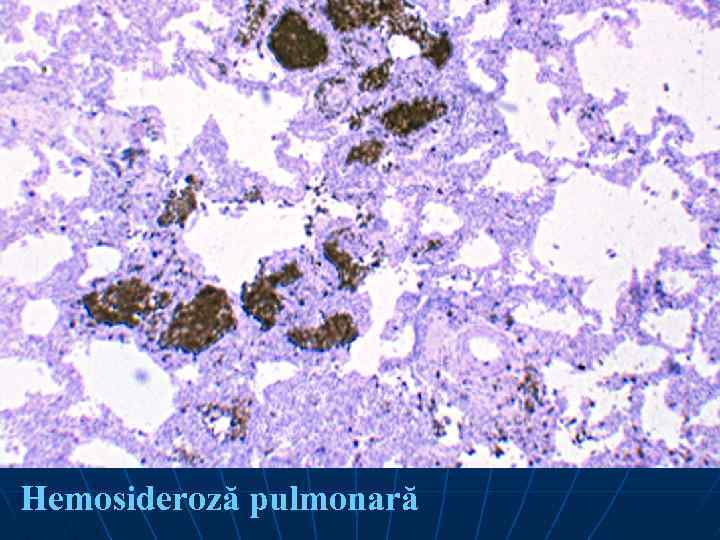 Hemosideroză pulmonară 