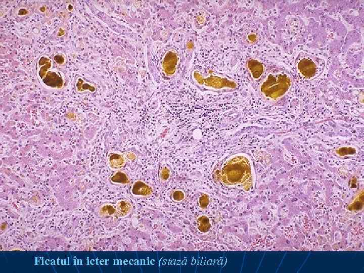 Ficatul în icter mecanic (stază biliară) 