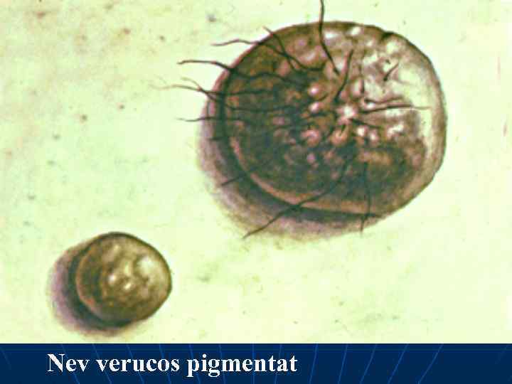 Nev verucos pigmentat 