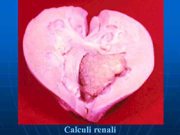 Calculi renali 