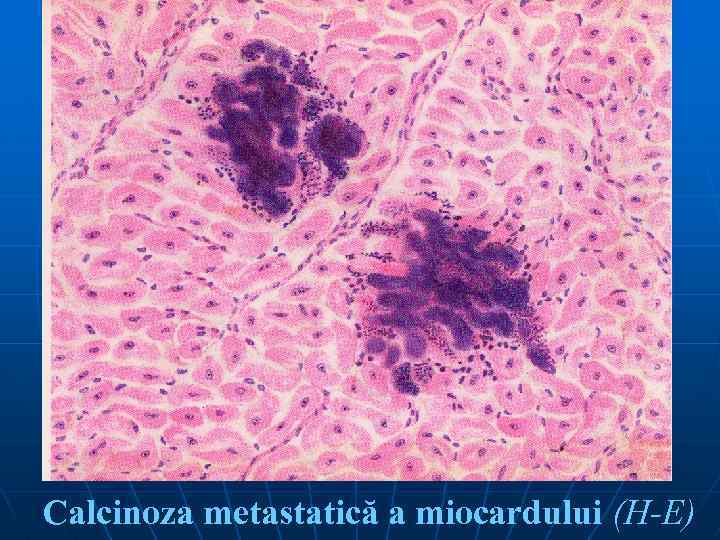 Calcinoza metastatică a miocardului (H-E) 