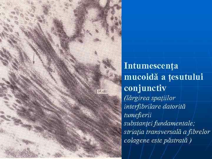 Intumescenţa mucoidă a ţesutului conjunctiv (lărgirea spaţiilor interfibrilare datorită tumefierii substanţei fundamentale; striaţia transversală