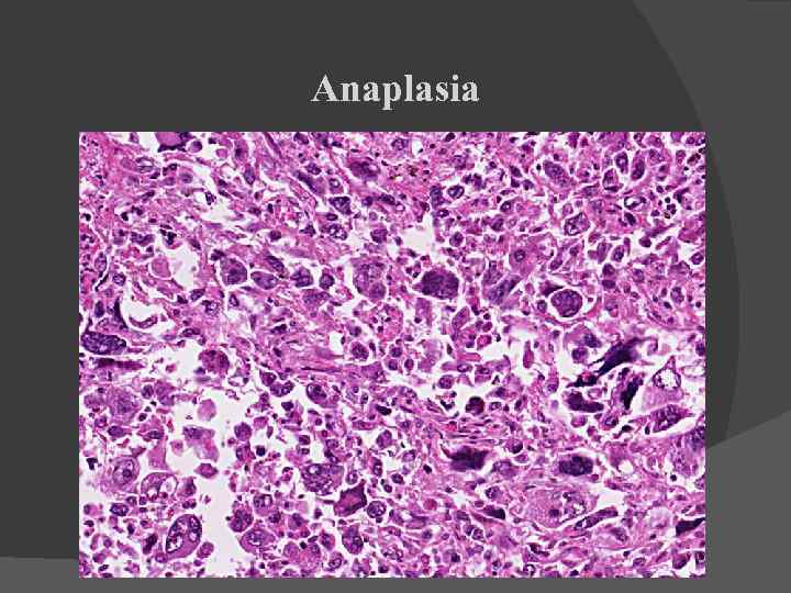 Anaplasia 