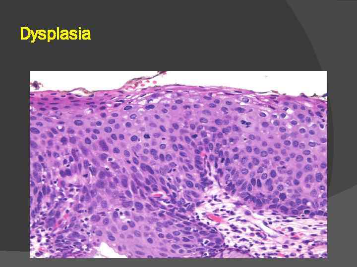 Dysplasia 