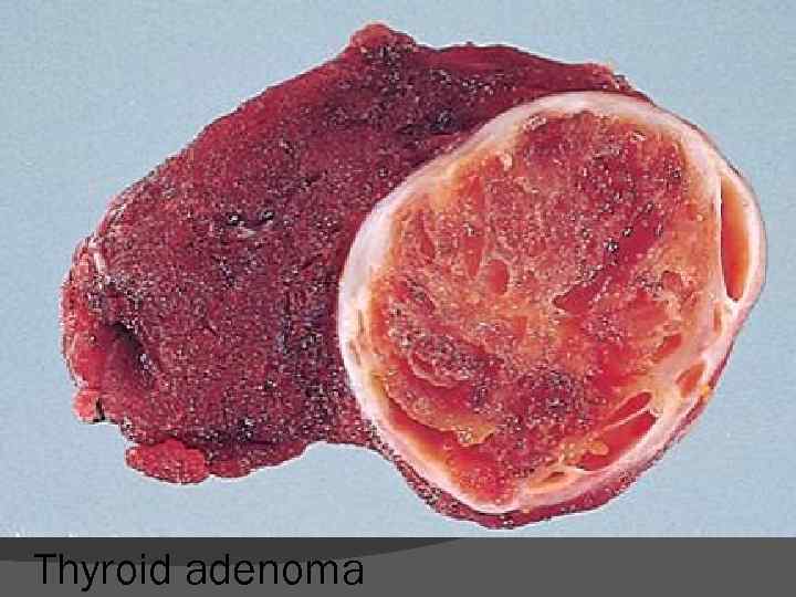 Thyroid adenoma 