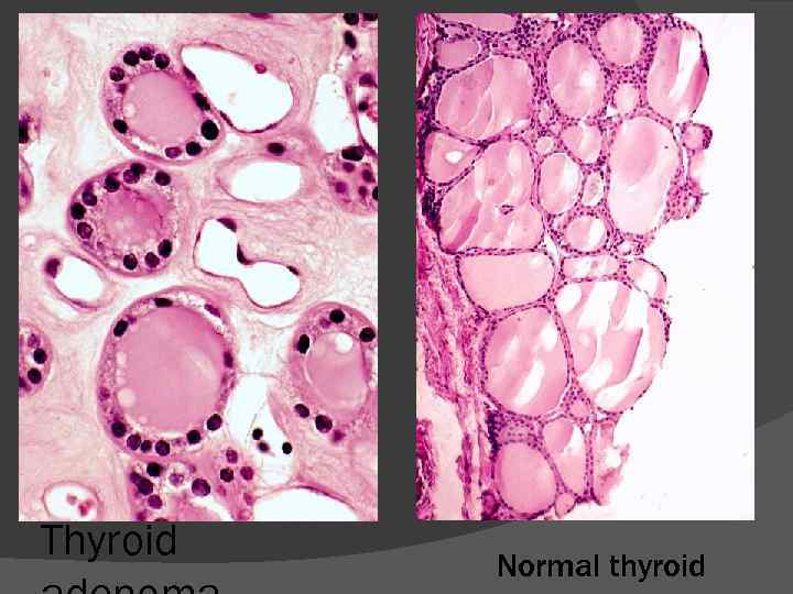 Thyroid Normal thyroid 