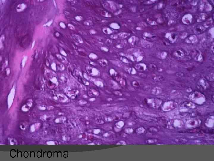 Chondroma 