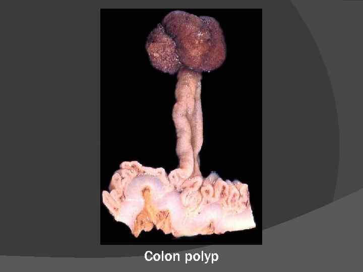 Colon polyp 