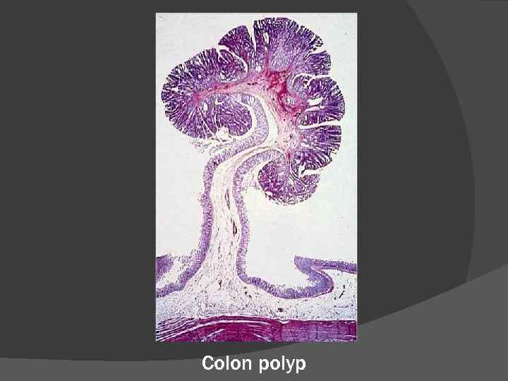 Colon polyp 