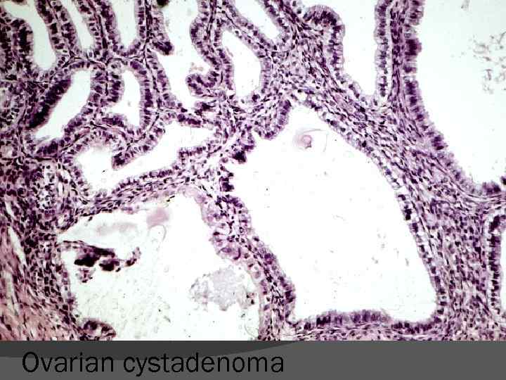 Ovarian cystadenoma 