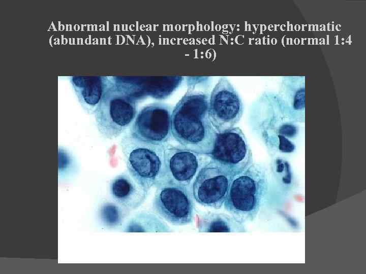 Abnormal nuclear morphology: hyperchormatic (abundant DNA), increased N: C ratio (normal 1: 4 -