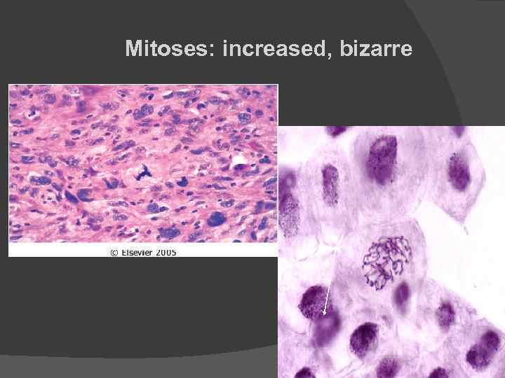 Mitoses: increased, bizarre 