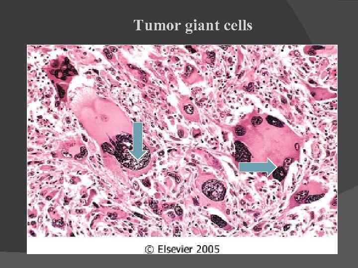 Tumor giant cells 