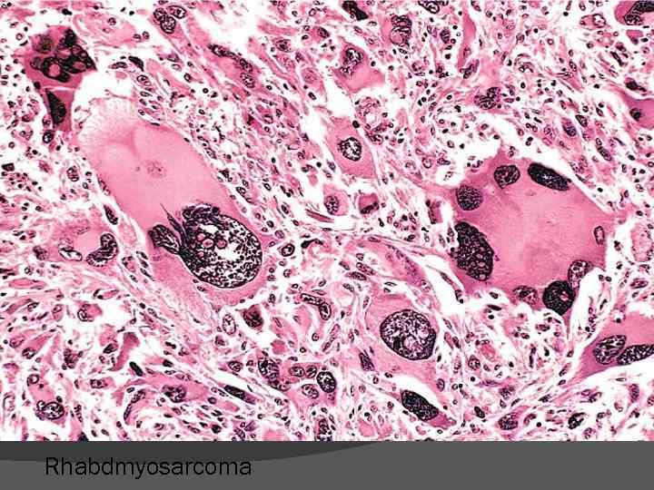 Rhabdmyosarcoma 