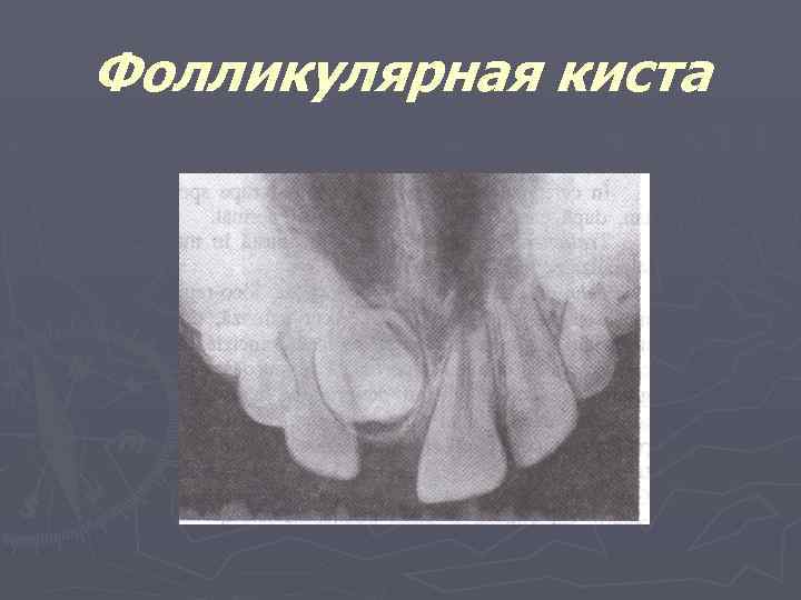 Фолликулярная киста 