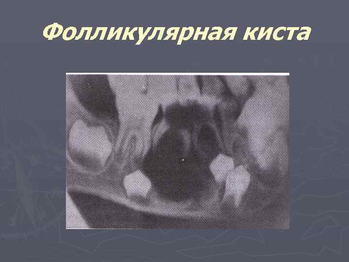 Фолликулярная киста 