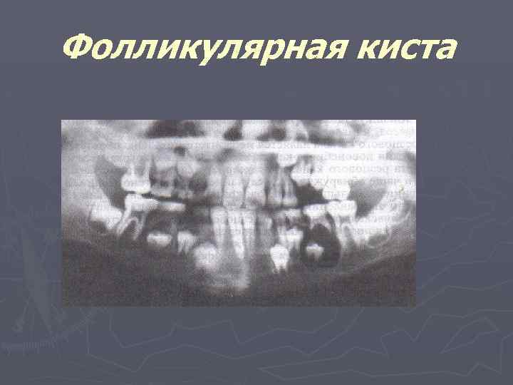 Фолликулярная киста 