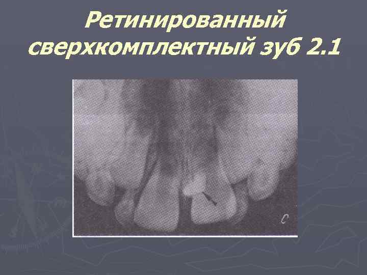 Ретинированный сверхкомплектный зуб 2. 1 