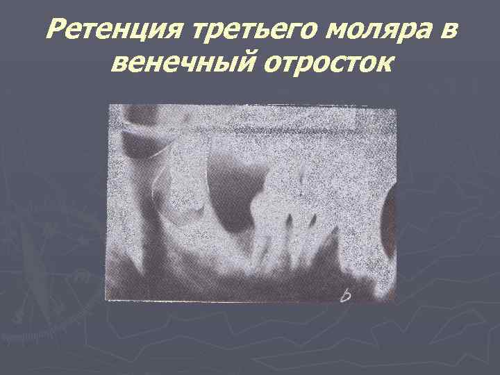 Ретенция третьего моляра в венечный отросток 