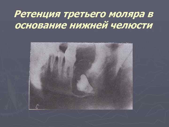 Ретенция третьего моляра в основание нижней челюсти 