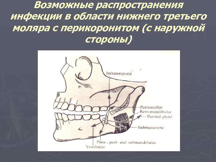 Возможные распространения инфекции в области нижнего третьего моляра с перикоронитом (с наружной стороны) 