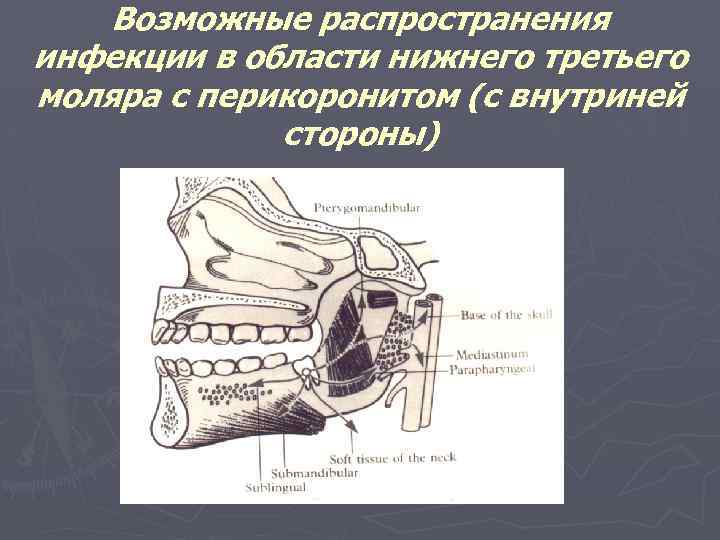 Возможные распространения инфекции в области нижнего третьего моляра с перикоронитом (с внутриней стороны) 