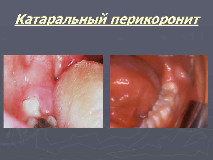 Катаральный перикоронит 