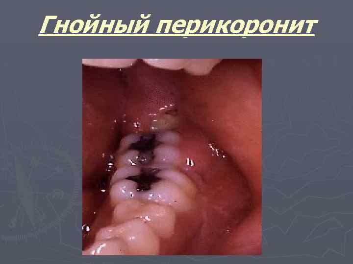 Гнойный перикоронит 