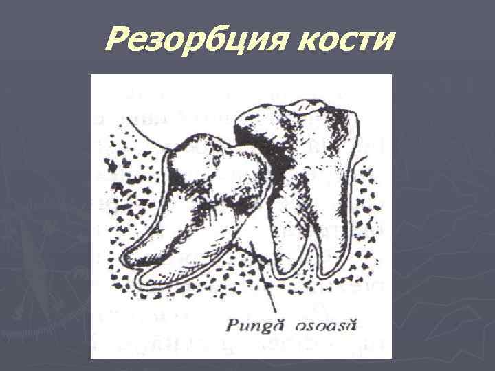 Резорбция кости 