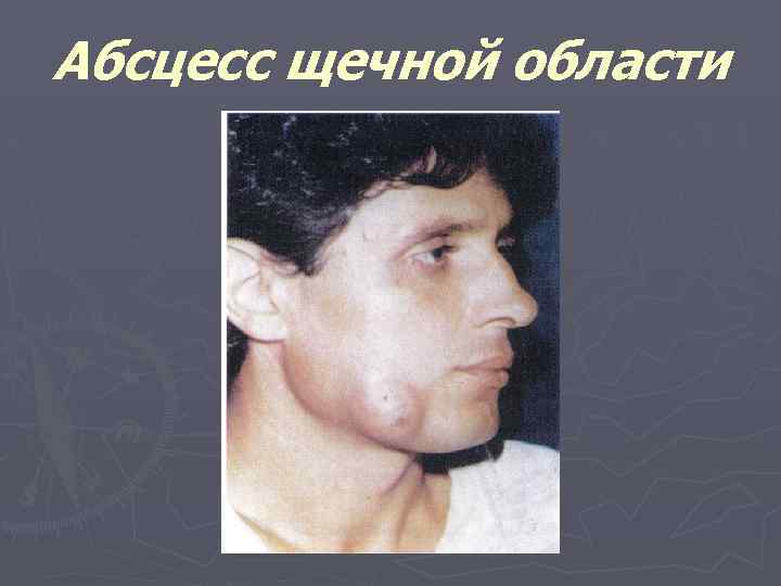 Абсцесс щечной области 
