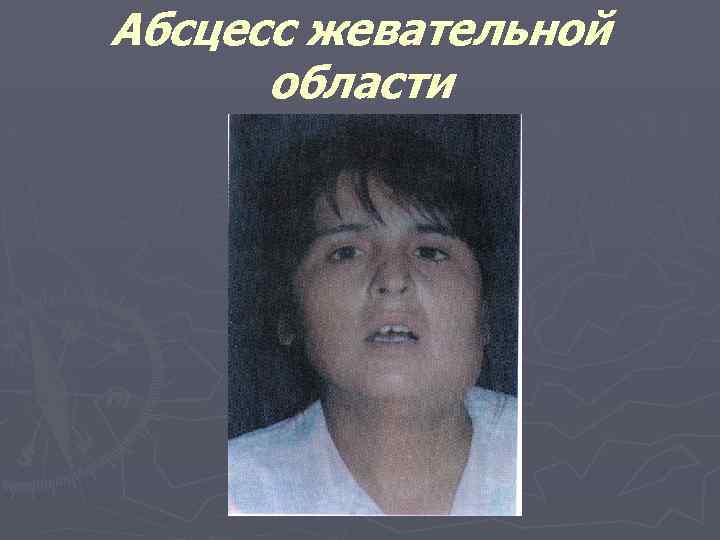 Абсцесс жевательной области 