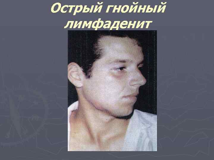 Острый гнойный лимфаденит 