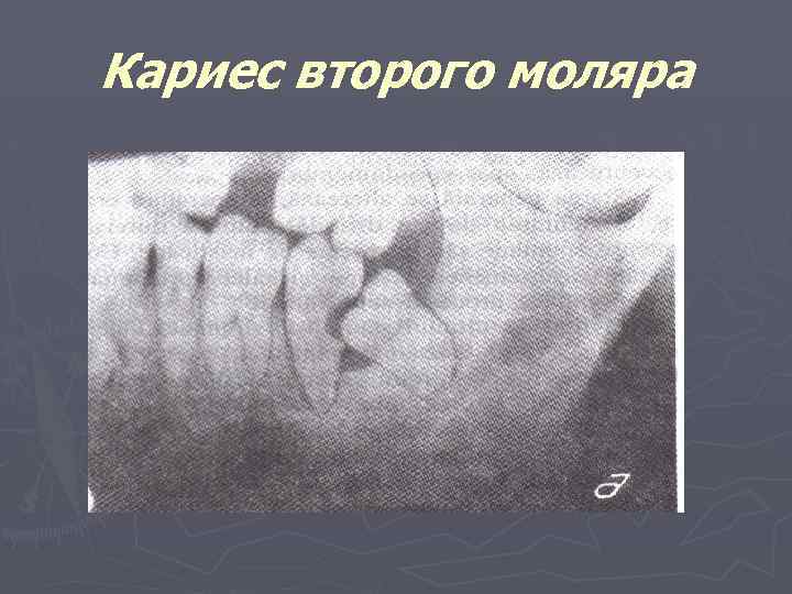 Кариес второго моляра 