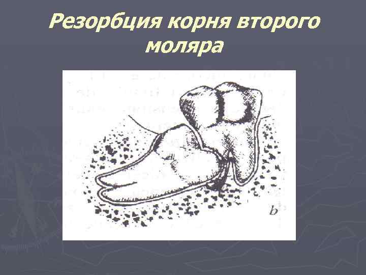 Резорбция корня второго моляра 