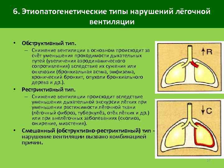 6. Этиопатогенетические типы нарушений лёгочной вентиляции • Обструктивный тип. – Снижение вентиляции в основном