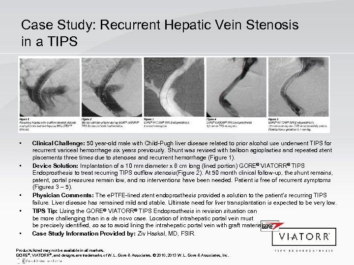 Case Study: Recurrent Hepatic Vein Stenosis in a TIPS • • • Clinical Challenge: